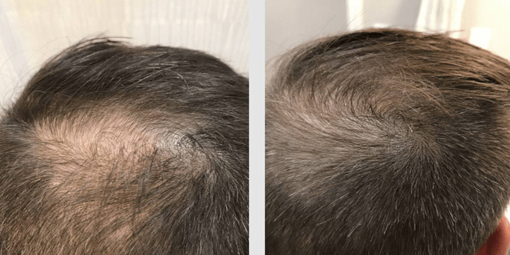 Results of laser cap for hair loss treatment Results of laser cap for hair loss treatment