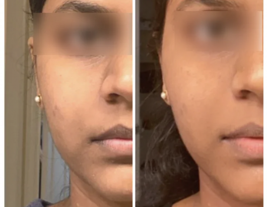 Skin improvement result after using Ziip device Skin improvement result after using Ziip device