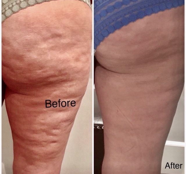 Results of getting rid of cellulite after 24 sessions of RLT Results of getting rid of cellulite after 24 sessions of RLT