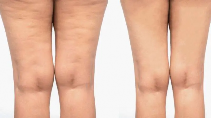 Results after cellulite laser treatment for 4 weeks Results after cellulite laser treatment for 4 weeks