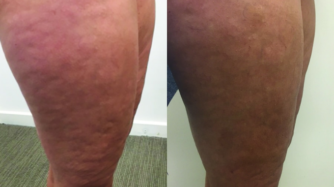 Before and after laser therapy for cellulite (7 weeks) Before and after laser therapy for cellulite (7 weeks)