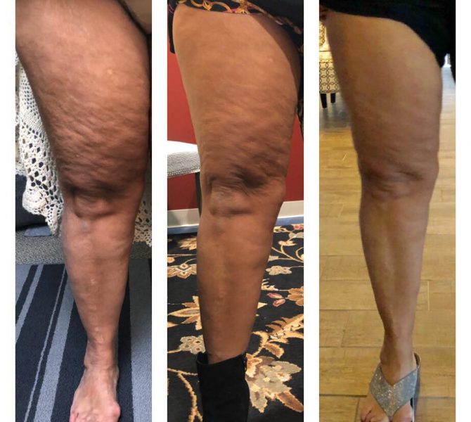 Results of getting rid of cellulite after 24 sessions of RLT Results of getting rid of cellulite after 24 sessions of RLT