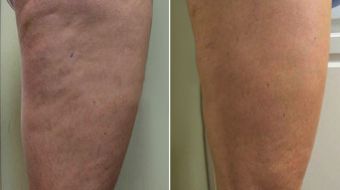 Before and after laser therapy for cellulite (2 months) Before and after laser therapy for cellulite (2 months)