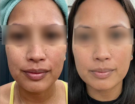 Skin improvement result after using Ziip device Skin improvement result after using Ziip device