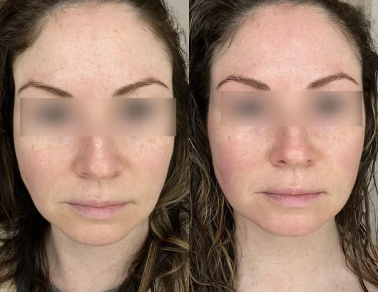 Skin improvement result after using Ziip device Skin improvement result after using Ziip device