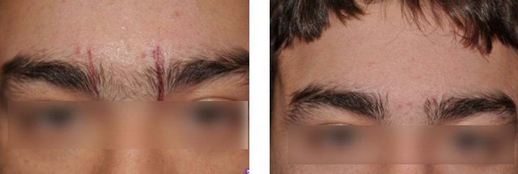 The result of using a diode laser for hair removal The result of using a diode laser for hair removal