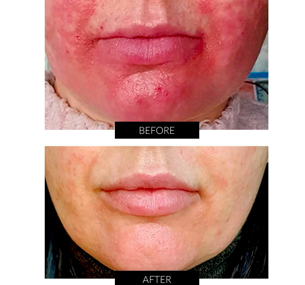Before & After laser treatment for rosacea