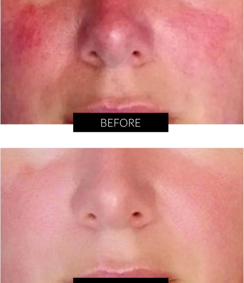 Before & After laser treatment for rosacea
