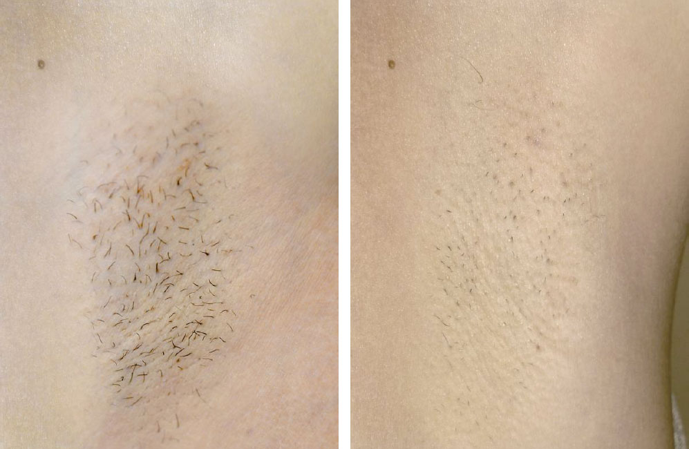 The result of using a diode laser for hair removal The result of using a diode laser for hair removal