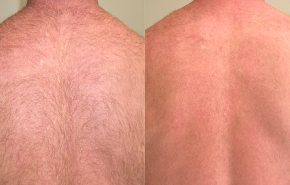 The result of using a diode laser for hair removal The result of using a diode laser for hair removal