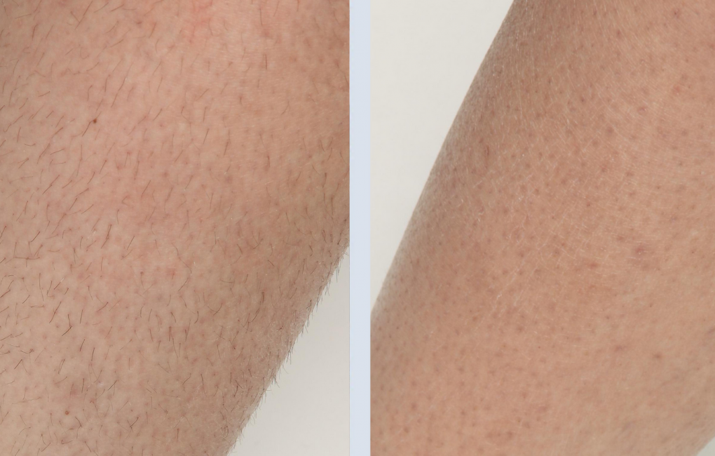 The result of using a diode laser for hair removal The result of using a diode laser for hair removal