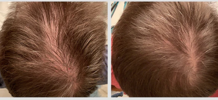 The result of using laser therapy for the treatment of hair loss in man The result of using laser therapy for the treatment of hair loss in man
