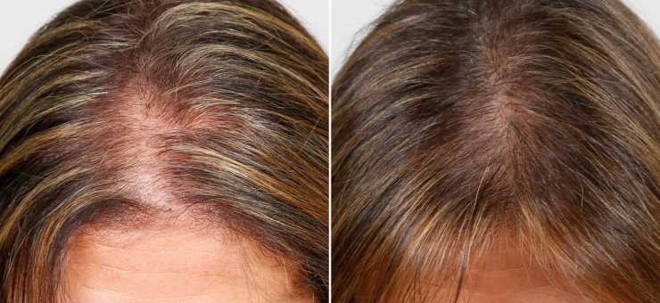 The result of using laser therapy for the treatment of hair loss in women The result of using laser therapy for the treatment of hair loss in women