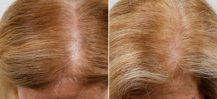 The result of using laser therapy for the treatment of hair loss in women The result of using laser therapy for the treatment of hair loss in women