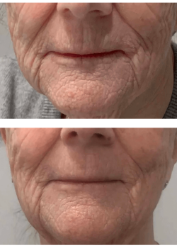 Result of LYMA for anti-aging (used daily for 4 months) Result of LYMA for anti-aging (used daily for 4 months)