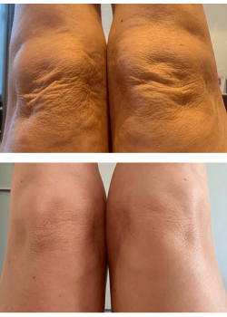 Result of LYMA for sagging treatment (used daily for 3 months) Result of LYMA for sagging treatment (used daily for 3 months)