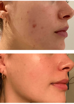 Result of LYMA for acne treatment (used daily for 3 months) Result of LYMA for acne treatment (used daily for 3 months)